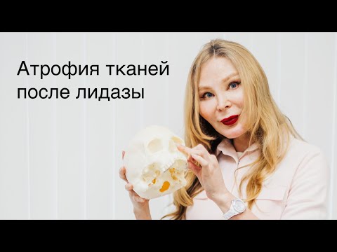 Видео: Результаты введения лидазы после филлеров
