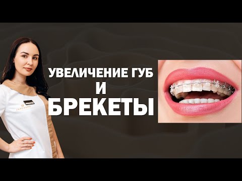 Видео: УВЕЛИЧЕНИЕ ГУБ И БРЕКЕТЫ 💉 МОЖНО ЛИ УВЕЛИЧИВАТЬ ГУБЫ ПРИ БРЕКЕТАХ⁉️🧐