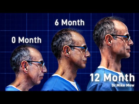 Видео: Ультимативное Руководство По Mewing От Доктора Майка Мью | ДЛЯ НАЧИНАЮЩИХ