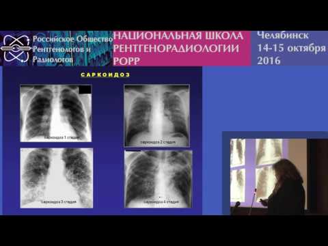 Видео: И.А. Соколина - Саркоидоз органов дыхания