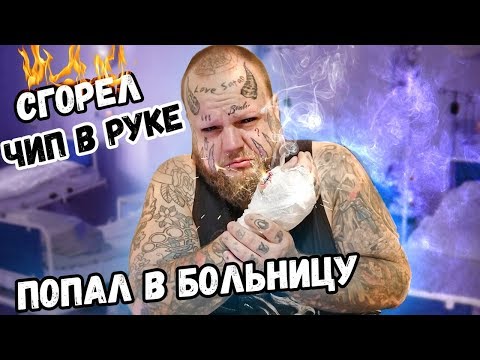 Видео: СГОРЕЛ RFID ЧИП В МОЕЙ РУКЕ | Последствия , Я ПОСТРАДАЛ