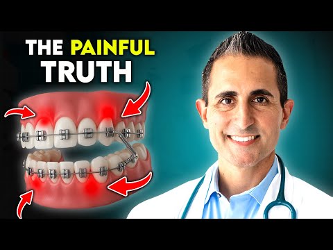 Видео: Действительно ли брекеты причиняют боль? Правда в том, что...