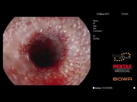 Видео: Стентирование пищевода