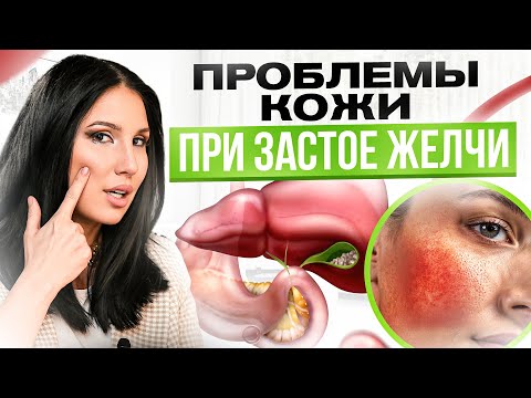 Видео: 10 признаков застоя желчи на коже. Что кожа расскажет о твоем желчном?