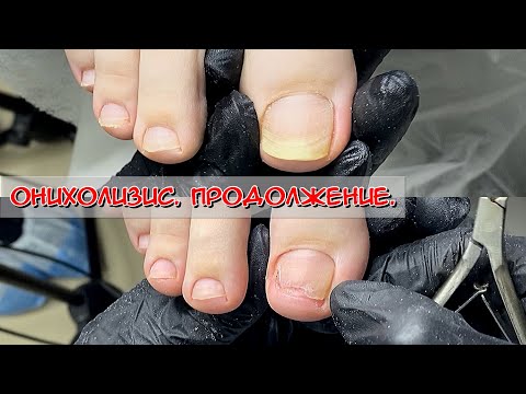 Видео: Онихолизис. Продолжение