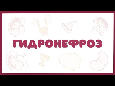 Видео: Гидронефроз - причины, симптомы, лечение (лекция) урология