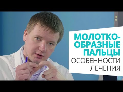 Видео: Молоткообразные пальцы: особенности лечения доктор Алексей Олейник #footclinic
