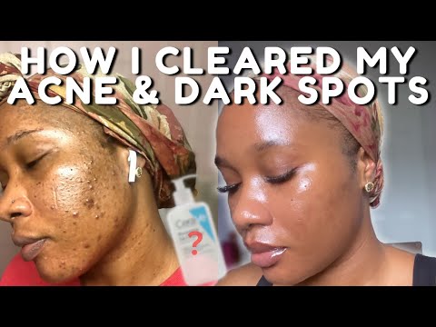 Видео: КАК Я ИЗБАВИЛСЯ ОТ АКНЕ И ТЕМНЫХ ПЯТЕН *БЕЗ ТРЕТИНОИНА* | iJay Amadi
