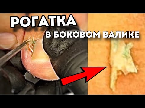 Видео: Вросшие углы ногтей на больших пальцах | формы вросших сегментов | ощущение пациента после процедуры