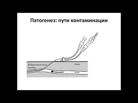 Видео: Каттетер-ассоцированная инфекция кровотока Бирг Т.М.