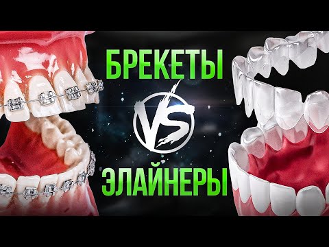 Видео: Исправление прикуса в 2025. Что выбрать – БРЕКЕТЫ или ЭЛАЙНЕРЫ?