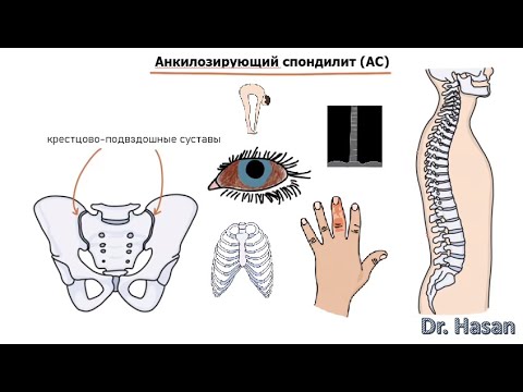 Видео: Анкилозирующий спондилит (болезнь Бехтерева) | определение, этиология, патогенез, клиника, диаг, леч