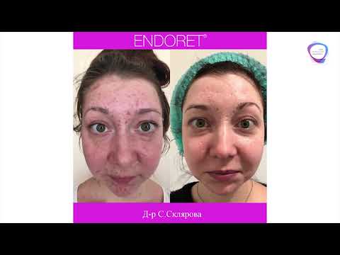 Видео: Лікування рубців після вітрянки: клінічний випадок