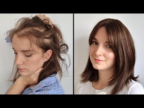 Видео: Андрогенетическая алопеция: мой кошмар, мое решение