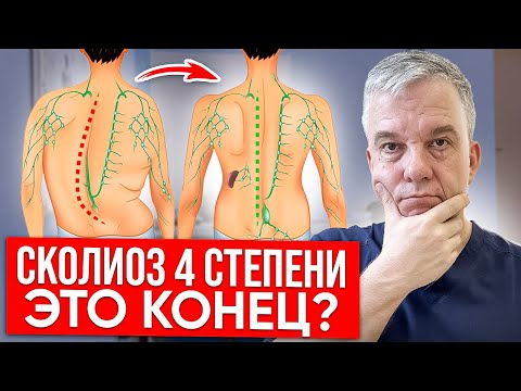 Видео: ЗАБУДЬ О БОЛИ В ПОЗВОНОЧНИКЕ ЗА ПОЛЧАСА! Лечение СКОЛИОЗА 4 степени, реально?