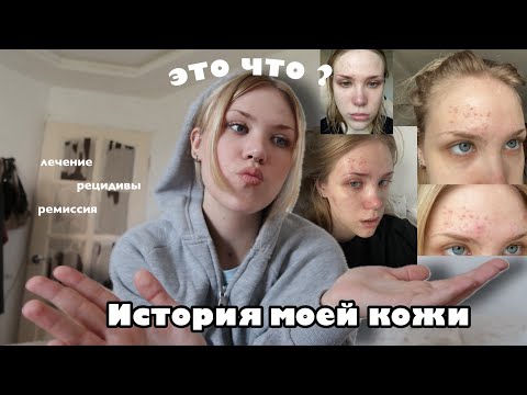 Видео: Мне ИСПОРТИЛИ кожу?? *лечу кожу 10 лет и уже не вывожу*help