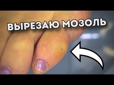 Видео: Опухший мизинец с мозолью | вырезаю корешок | результат до/после
