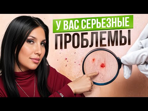 Видео: Красные точки, родимые пятна, родинки , кератомы… Сигналы, что ваш организм в опасности!