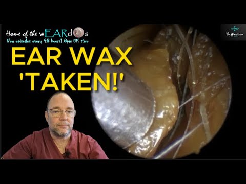 Видео: Ушная сера «взята» 256 #ухо #ушнаясера #удалениеушнойсеры #чисткаушей #fyp #длявас #asmr #удовлет...