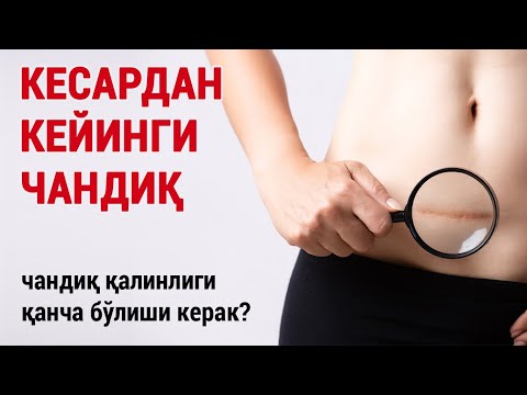 Видео: Кесардан кейинги чандиқ. Чандиқ қалинлиги қанча бўлиши керак?
