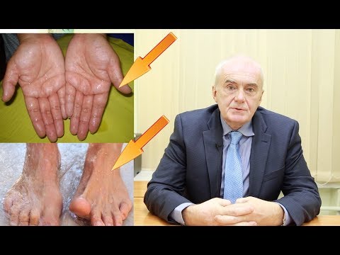 Видео: Потеют и руки, и стопы. Совмещение торакальной и поясничной симпатэктомии?