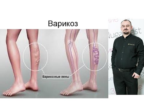 Видео: Варикоз