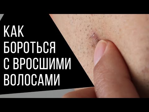 Видео: Вросшие Волосы: Мой Опыт и Научные Факты. Как Бриться Без Проблем?