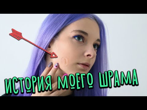 Видео: ИСТОРИЯ МОЕГО ШРАМА - ОТКУДА У МЕНЯ ШРАМ?