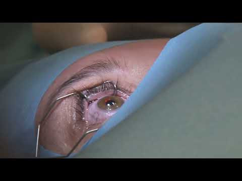 Видео: Трансляция коррекции зрения по технологии Femto Lasik в клинике премиум-класса КОРД