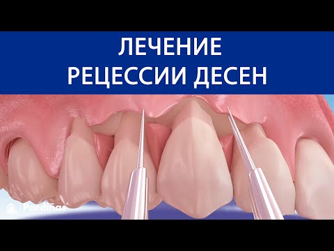 Видео: Фронтально смещенный лоскут - лечение рецессии десен ©