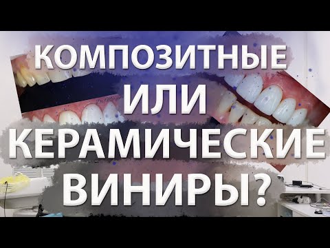 Видео: Композитные виниры или керамические