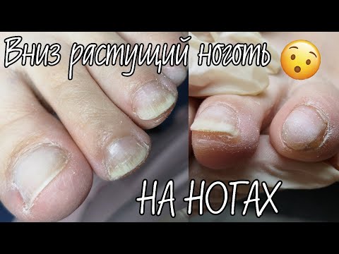 Видео: Искривление пальцев ног. Вниз растущий ноготь на ногах. Классический, обрезной педикюр с гель-лаком