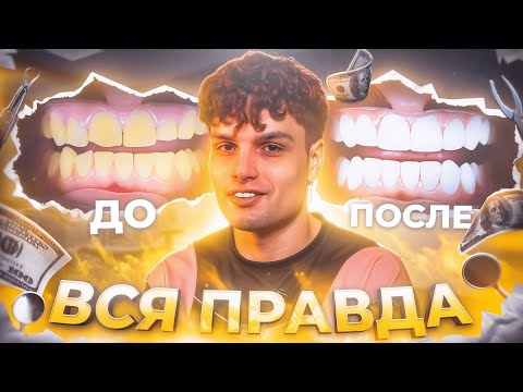 Видео: Я поставил Виниры — Правда, Ошибки и то, о чём молчат врачи
