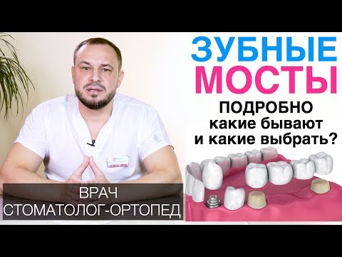 Видео: Все о зубных мостах - виды, материалы, гарантия. Металлокерамические и циркониевые мосты для зубов