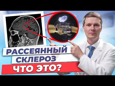 Видео: Что такое рассеянный склероз?