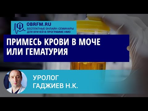 Видео: Уролог Гаджиев Н.К.: Примесь крови в моче или гематурия
