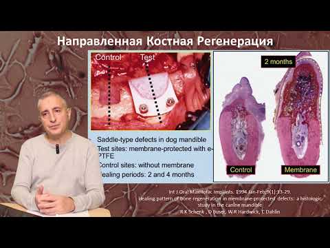 Видео: Направленная Костная Регенерация (НКР) Часть 1. Мембраны
