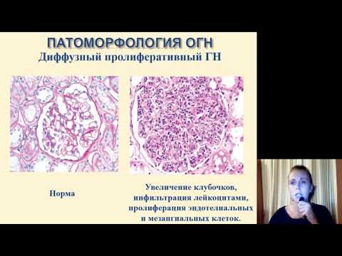 Видео: Фак. терапия (Внутренние болезни). Гломерулонефриты. ХБП