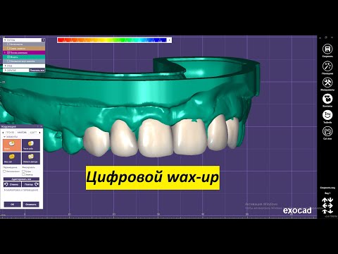 Видео: EXOCAD Моделировка waxup для дальнейшей печати модели. Цифровое моделирование зубов.