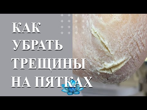 Видео: Как убрать трещины на пятках.