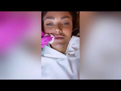 Видео: Филлер Stylage M .  Инъекционная косметология .  Обзор как мы делали губки бантиком.