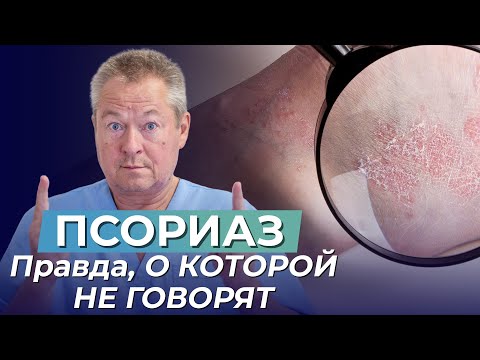 Видео: ПСОРИАЗ? ЛЕЧИТЕ КИШЕЧНИК, А НЕ КОЖУ! Правда, О КОТОРОЙ НЕ ГОВОРЯТ врачи!