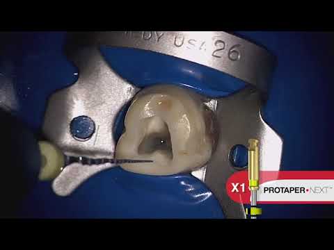 Видео: Proglider и Protaper Next: обработка корневого канала легко и быстро