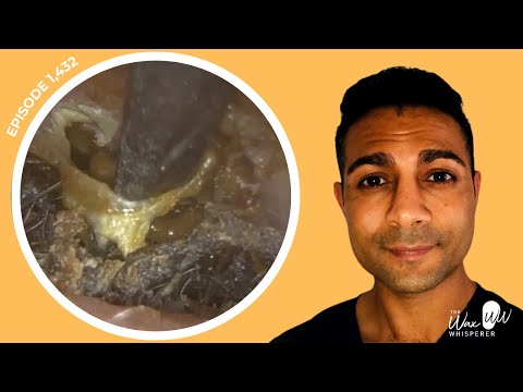 Видео: 1432 — Под серной пробкой и омертвевшим слоем кожи обнаружена возможная редкая форма холестеотомы...