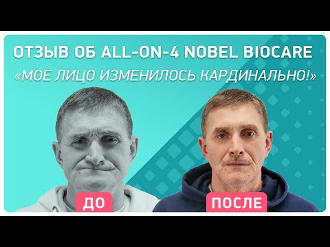 Видео: Отзыв об All-on-4 Nobel Biocare – кардинальное изменение прикуса и лица