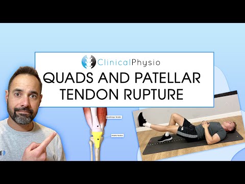 Видео: Разрыв сухожилий четырёхглавой мышцы бедра и надколенника | Обзор эксперта-физиотерапевта