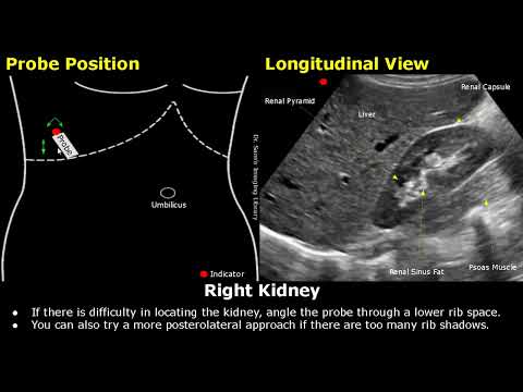 Видео: Расположение датчика для УЗИ почек | Размещение и сканирование датчика | УЗИ брюшной полости | Со...