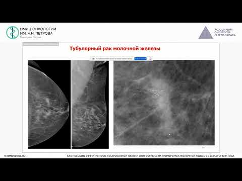 Видео: Редкие типы РМЖ