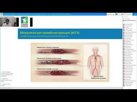 Видео: Оказание медицинской помощи пациентам с ишемическим инсультом на фоне фибрилляции предсердий