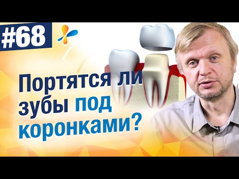 Видео: Портятся ли под коронками зубы?